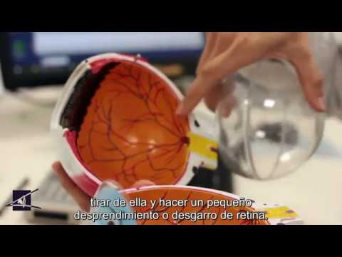 El desprendimiento de retina y su tratamiento.