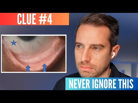 AI reveals 10 clues of early colon cancer