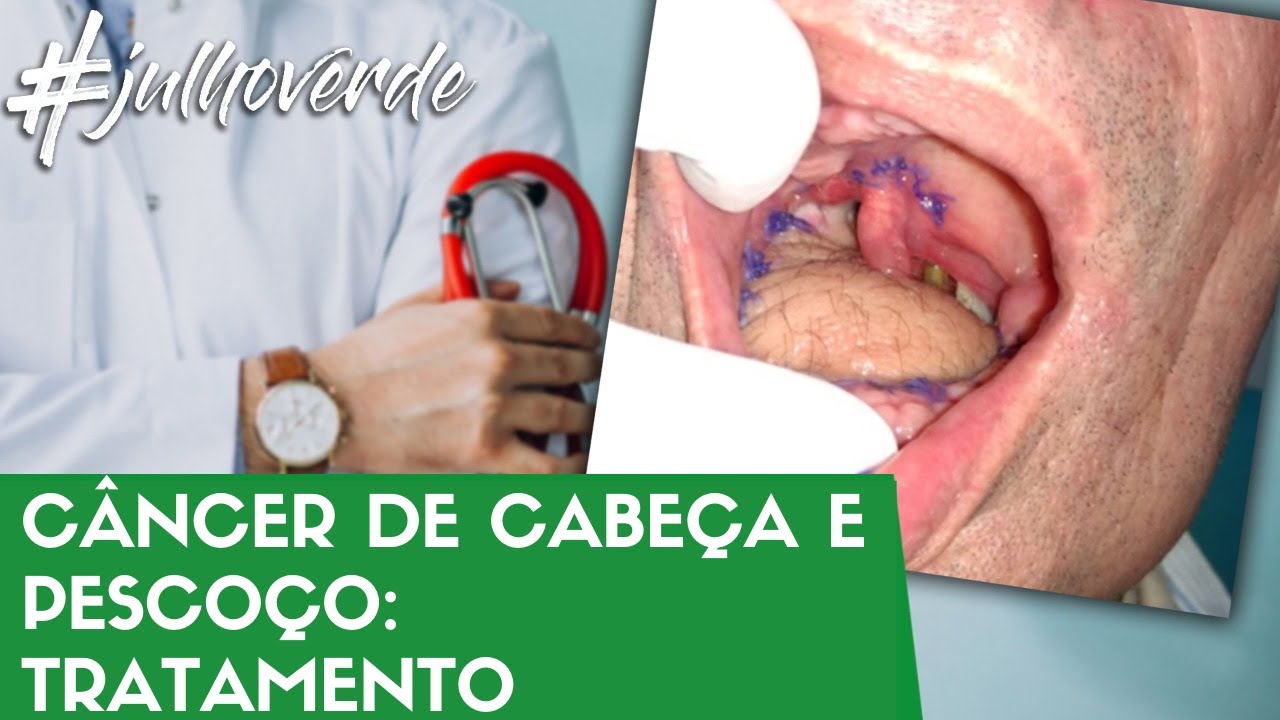 Tratamento do câncer de cabeça e pescoço - Radioterapia? Quimioterapia? | Campanha Julho Verde