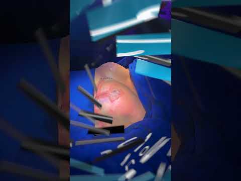 Video Cirugía de mama