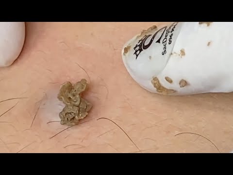 Popping large CYST on the chest