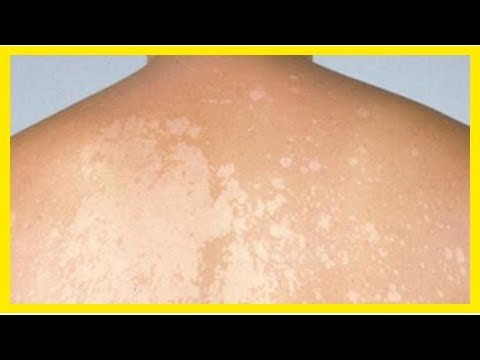 Vous avez des taches blanches qui apparaissent sur la peau ? Voilà ce ...