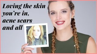 Bella Thorne on Loving Her Skin — Including Her Acne Scars | Pretty Unfiltered