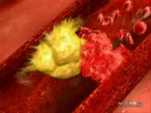 Myocardial Infarction/ Heart Attack explanation and animation