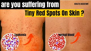Symptoms Of Leukemia | Leukemia Tiny Red Spots On Skin | Chronic Myeloid Leukemia Symptoms