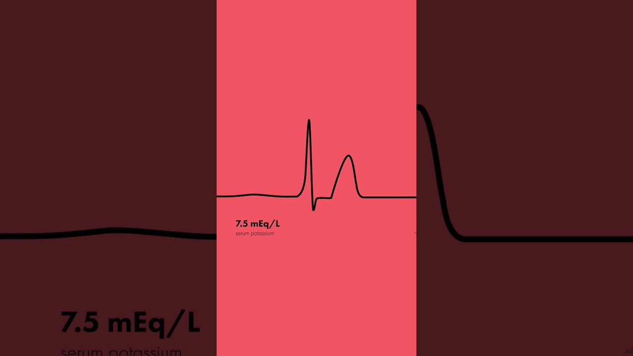 Hyperkalemia ECG Findings - Shorts