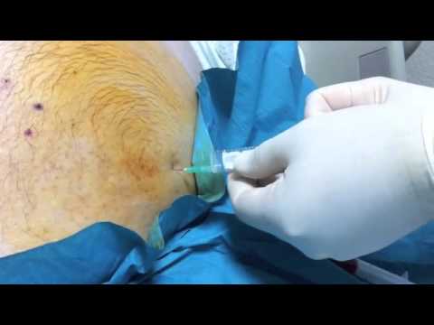 Pocket-Sized Ultrasound Leaded Incision Of The Abdomen