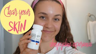 How To Get Rid of Acne / My Doxycycline Experience