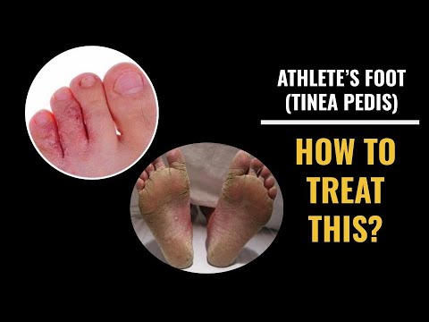 Athlete's Foot (Tinea Pedis) - How do you treat this?