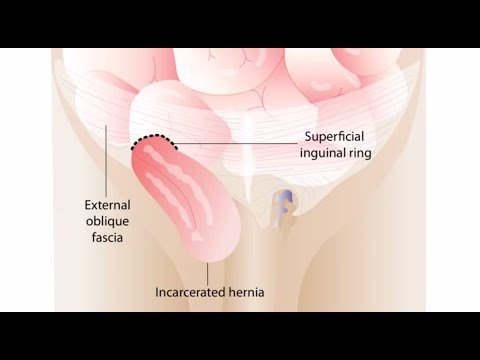 Right Inguinal Hernia Repair (Male Patient)