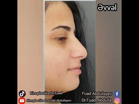 Dr Fuad Abdullayev - Estetik Cərrah -(LOR)nvan:Uni klinikaƏlaqə:+994553410032