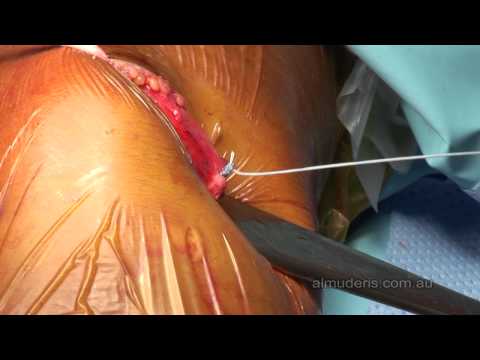 MPFL reconstruction for Patella dislocation 