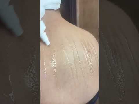 How to Treat Back Acne | How to Treat Body Acne | #AcneTreatment | Nipun Kapur