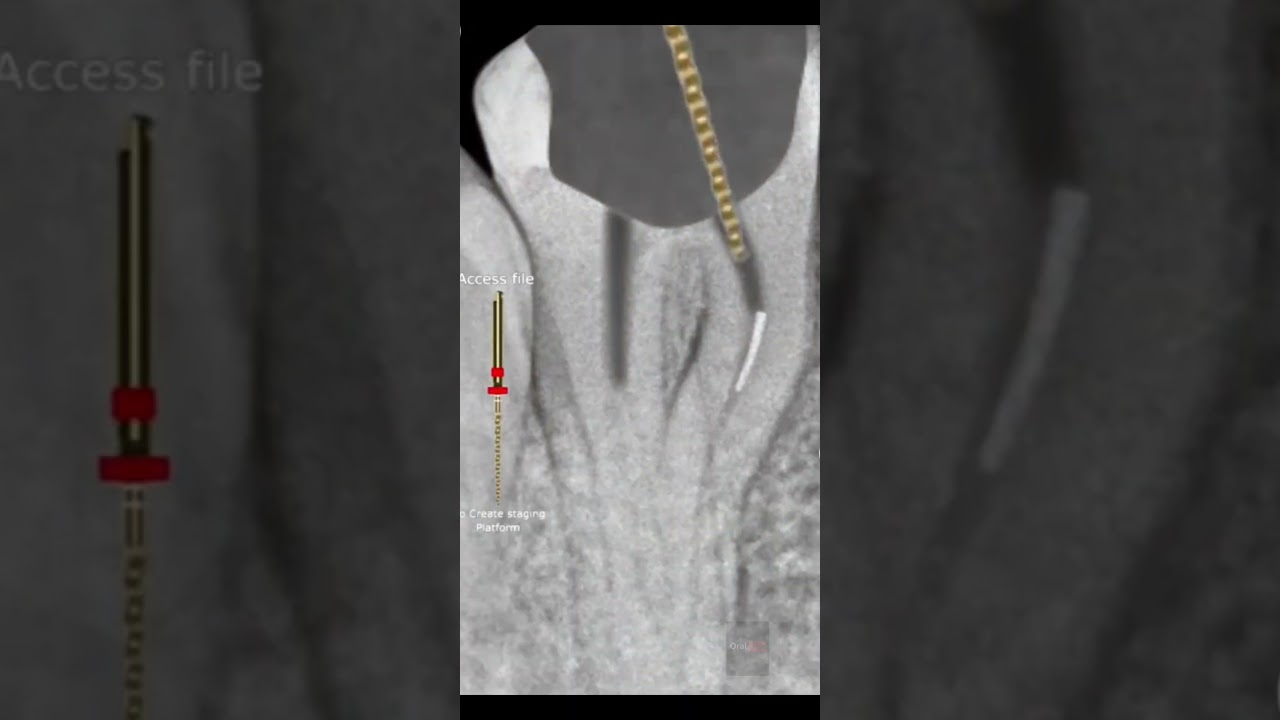 RCT Procedure with Broken Instrument Inside Root Canal | Step-by-Step Case🦷😲#shorts #viralshorts