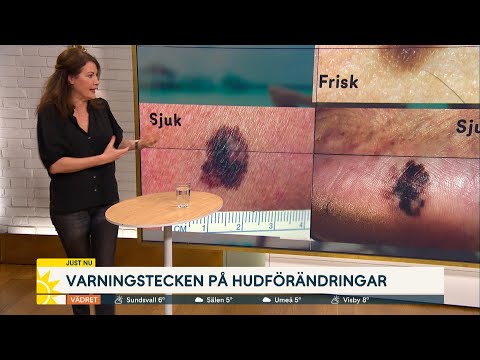 Hudcancer ökar dramatiskt – så ser en farlig leverfläck ut | Nyhetsmorgon | TV4 & TV4 Play