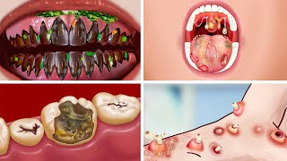 ASMR Tooth Decay & Pimple Removal on Hands | Animated Pimple Treatment