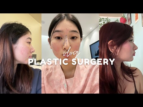 I Got a NOSE JOB IN KOREA (1 week recovery + results) | vlog