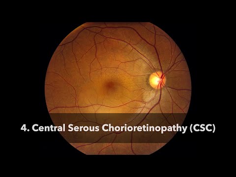 Central Serous Chorioretinopathy (CSC)