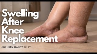 3 Tips to Reduce Swelling in the Foot and Ankle After Total Knee Replacement