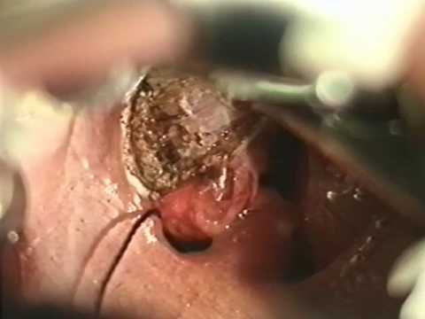 Laser assisted tonsillectomy / tonsillotomy