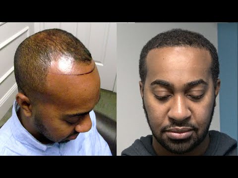 Frontal Hairline Reconstruction at Hair Restoration...