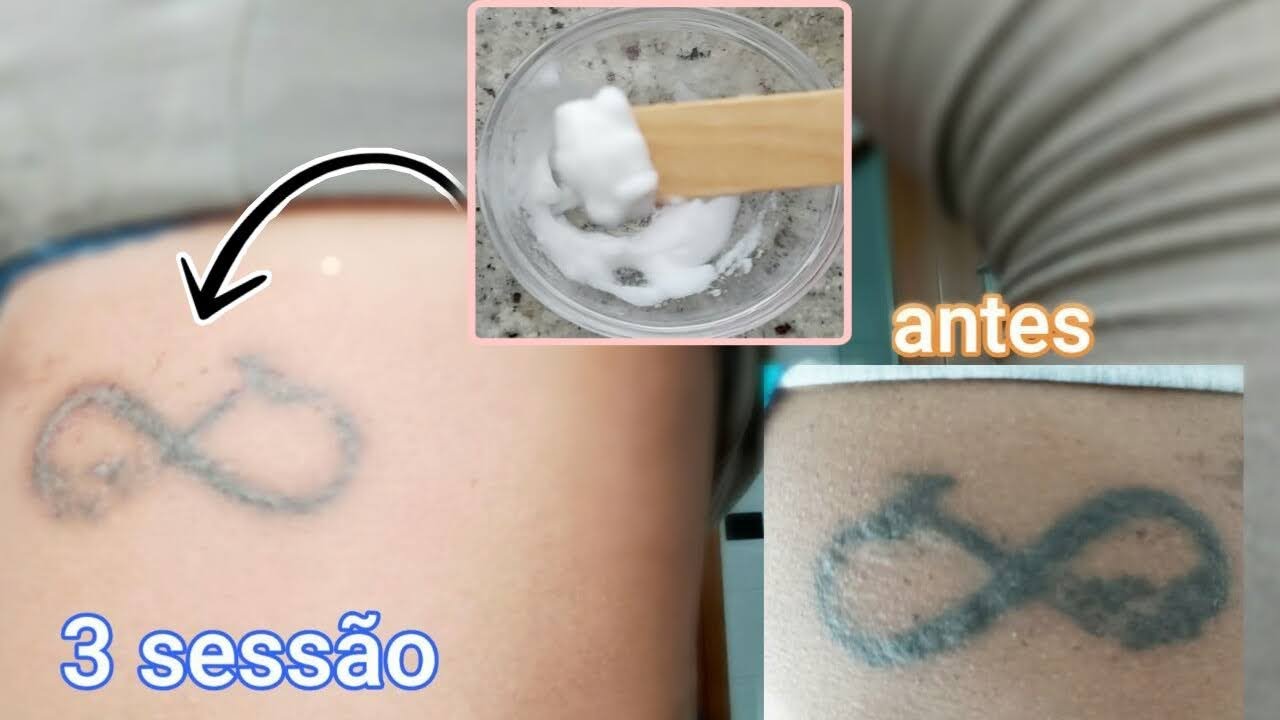 COMO REMOVER TATUAGEM EM CASA COM ESFOLIAÇÃO | APENAS 1 INGREDEENTE
