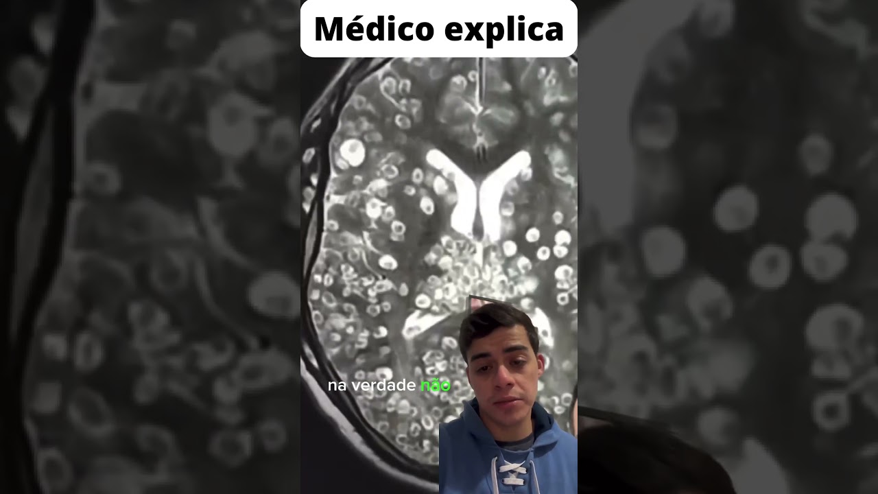 Problema especialmente com porco! #neurocisticercose #neurologia #cerebro #inteligencia #vermes
