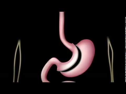 Cirugía Obesidad y Diabetes (Sleeve Gástrico o Sleeve Gastrectomy)