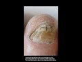 Signs Of Fungal Nail Infection - Nail Fungus What To Look For #fungalnails #fungalinfection