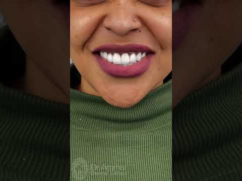 نتائج — ابتسامة هوليوود