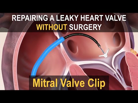 MITRAL VALVE CLIP (MitraClip/Pascal) | Repairing a Leaky Heart Valve without Surgery