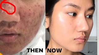 How to remove ACNE SCARS & Hyperpigmentation NATURALLY AT HOME | Home Remedies with 100% RESULTS |