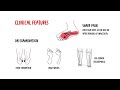 Plantar Fasciitis (Plantar Heel Pain): Causes, Diagnosis, Exercises & Evidence-Based Treatment