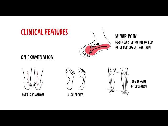 Plantar Fasciitis (Plantar Heel Pain): Causes, Diagnosis, Exercises & Evidence-Based Treatment