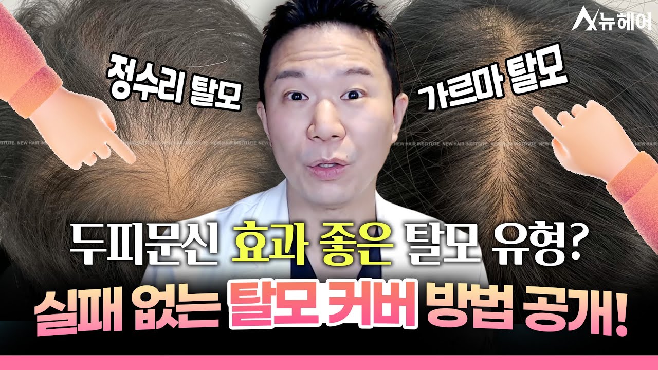  정수리탈모를 치료할 수 있는 현실적인 '이 방법'ㅣ뉴헤어