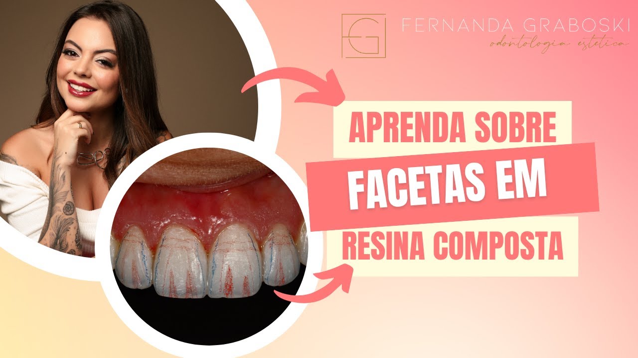 Como realizar e planejar um caso de Faceta em Resina Composta