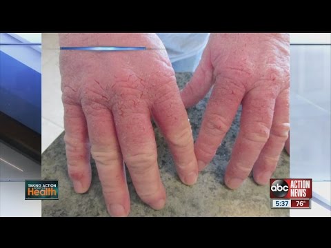 Quello che è necessario da psoriasi Trasferimento sulla psoriasi di cosa principale