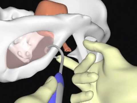 TOT trocar insertion (by YLTAN)