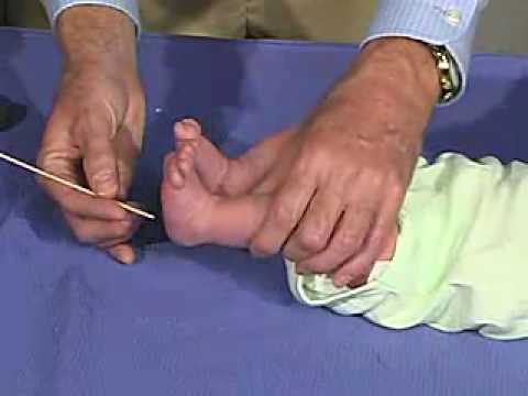 physical exam -Newborn Normal: Reflexes - Plantar Reflex