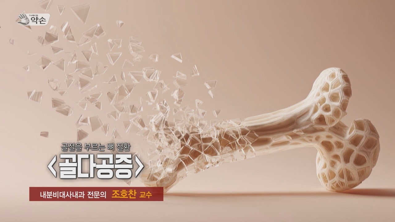 골절을 부르는 뼈 질환, '골다공증' ㅣ 내분비대사내과 조호찬 교수