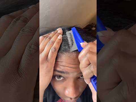 Remove Dandruff At Home ✅ #glowup #hair #shorts #shortvideo
