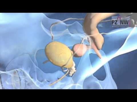 Prostata in Remission Ischias oder Prostatitis