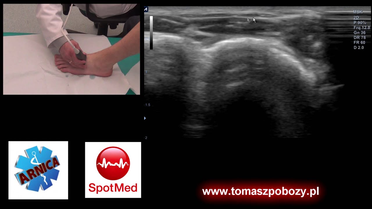 USG stawu skokowego i stopy