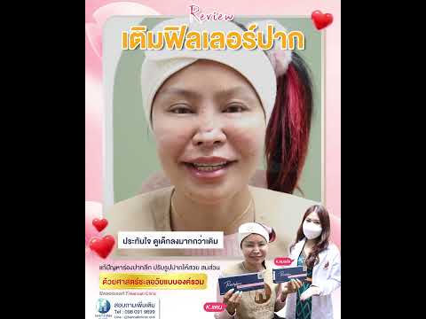 รีวิวหัตถการโปรแกรมฟิลเลอร์ปาก