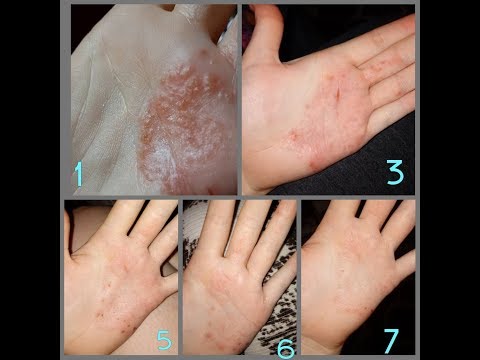 Tattica del dottore a psoriasi Eczema microbico strade nazionali di trattamento