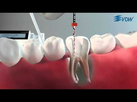 VDW Dental · How To: RECIPROC 7/8 (ZH)