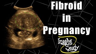 Pregnancy with Uterine Fibroid || Ultrasound || Case 76