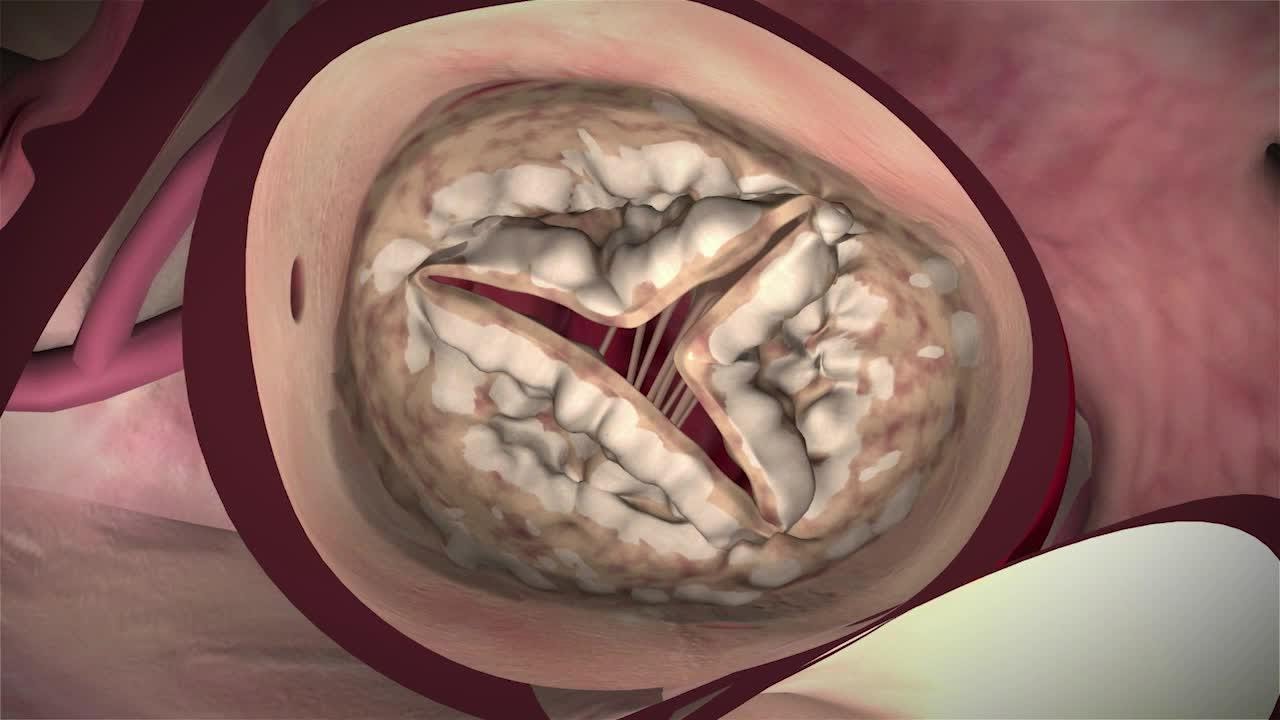 Aortic Valve Surgery