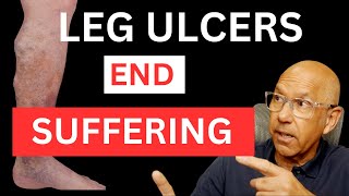 End Leg Ulcer Suffering: The Simple Solution You NEED to Know; Leg Ulcer Pain Relief