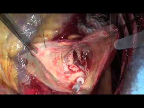 Posizione del corpo durante il sonno a osteocondrosi cervicale Il mal di schiena e della colonna vertebrale dopo il parto